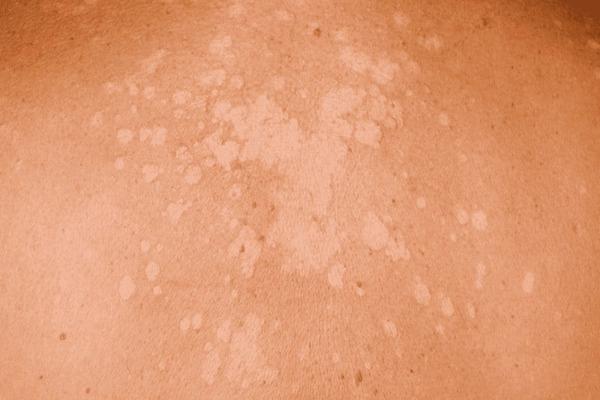 Bệnh nấm da: Nguyên nhân và những hậu quả khôn lường