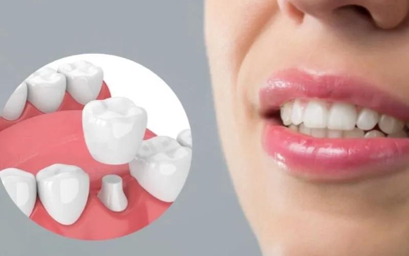 Biến chứng sau khi bọc răng sứ: Những dấu hiệu không nên chủ quan