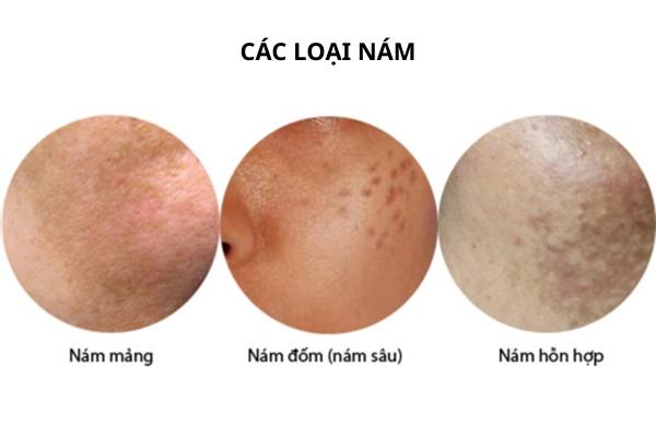 Các loại nám da thường gặp: Đặc điểm và nguyên nhân hình thành nám da