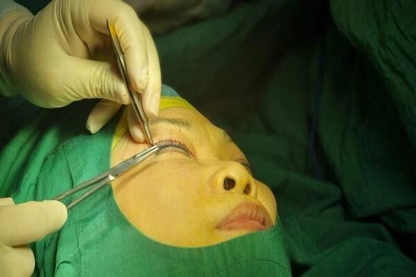 Cắt mí có đau không? Giải đáp thắc mắc về cắt mí an toàn