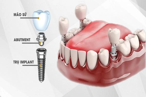 Cấy ghép Implant là gì? Ưu điểm của trồng răng Implant