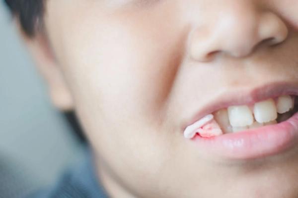 Chảy máu sau nhổ răng khôn: Nguyên nhân và cách xử lý