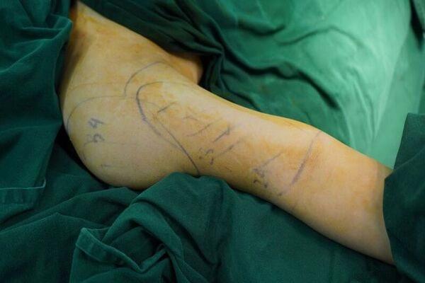 Hút mỡ bắp tay an toàn tại Thẩm mỹ Bệnh viện Hồng Ngọc