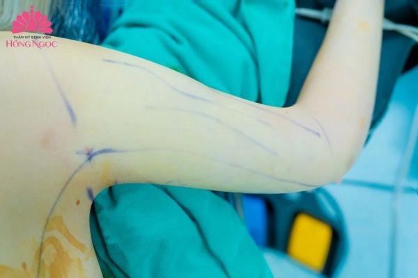 Hút mỡ bắp tay an toàn, hiệu quả tại Thẩm mỹ Bệnh viện Hồng Ngọc