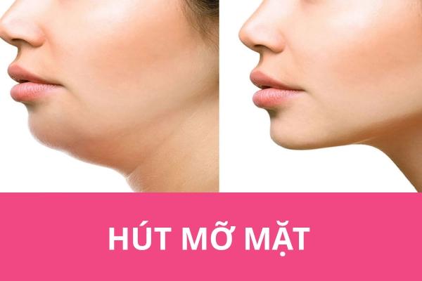 Hút mỡ mặt - Giải pháp lấy lại gương mặt thon gọn, thanh tú