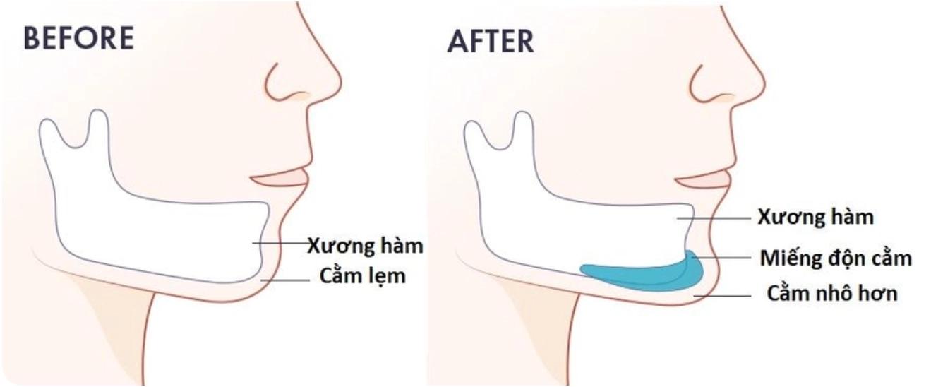 Ưu và nhược điểm của độn cằm: Có nên làm hay không?