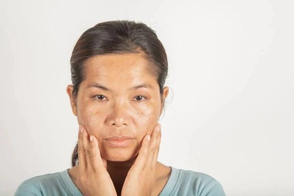 Nám da sau sinh: Nguyên nhân và cách điều trị an toàn cho mẹ bỉm