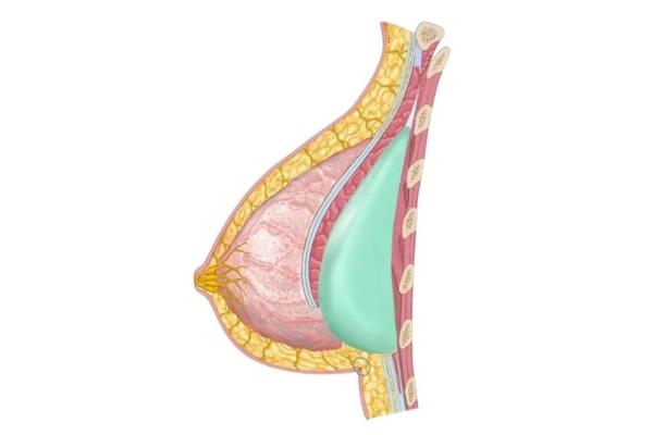 Nâng ngực Dual Plane - Kỹ thuật nâng ngực tiên tiến nhất hiện nay