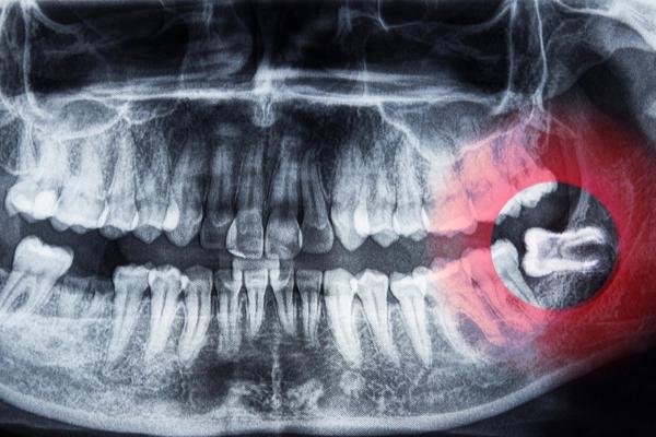 Nhổ răng khôn cho người cao tuổi và những lưu ý quan trọng để đảm bảo an toàn