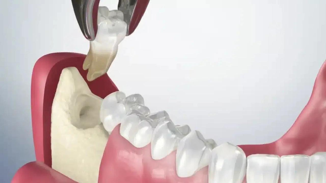 Chi phí nhổ răng 8 bao nhiêu? Những điều bạn cần biết trước khi điều trị