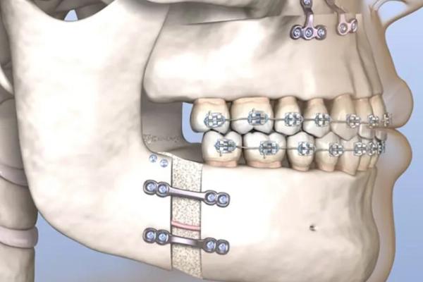 Niềng răng kết hợp phẫu thuật chỉnh hình hàm mặt - Giải pháp toàn diện cho nụ cười và khuôn mặt hài hòa