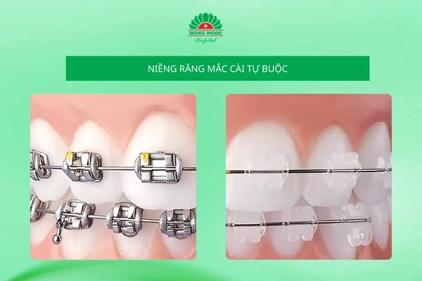 Niềng răng mắc cài tự buộc là gì? So sánh mắc cài tự buộc với mắc cài truyền thống