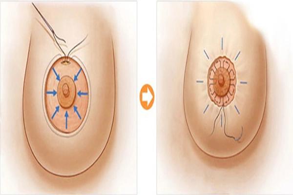 Tái tạo núm vú và quầng vú: Quy trình thực hiện chuẩn y khoa