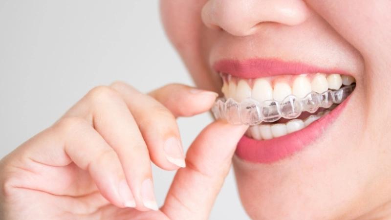 Chỉnh nha Invisalign - Niềng răng “vô hình”, tự tin ngay cả khi đang niềng