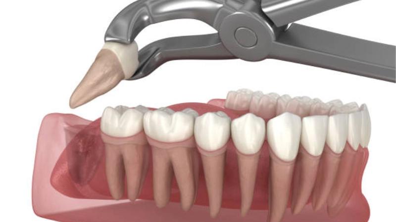 Chăm sóc đúng cách để hồi phục nhanh sau khi nhổ răng khôn