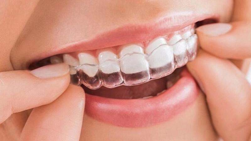 Niềng răng trong suốt: Giải pháp thẩm mỹ cho người nổi tiếng