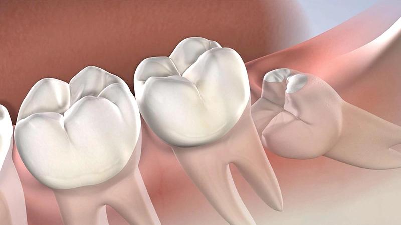 Nhổ răng khôn - Giải quyết dứt điểm đau nhức, ngăn biến chứng nguy hiểm
