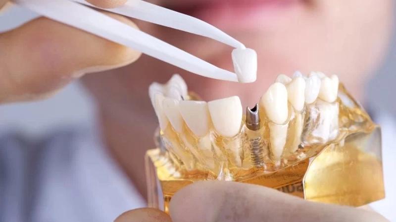 Chăm sóc răng Implant và vệ sinh đúng cách là như thế nào?