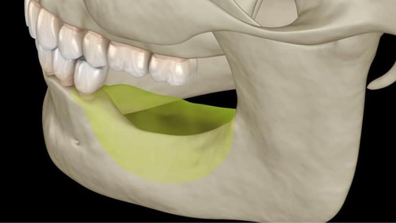 Trồng răng Implant - Giải pháp cho người bị mất răng lâu năm 