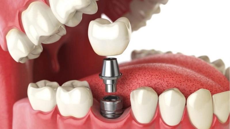 Mất răng không còn là nỗi lo khi có giải pháp trồng Implant