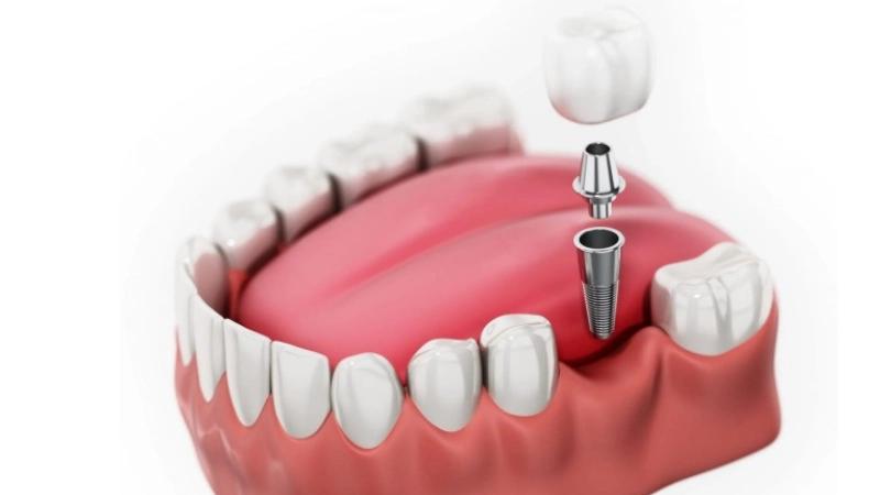 Trồng răng Implant - Bảo vệ sức khỏe răng miệng lâu dài