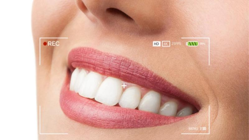 Tẩy trắng răng - Bí quyết cho nụ cười tự tin, trắng sáng