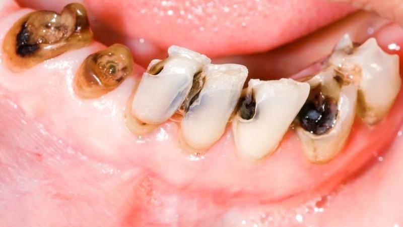 Phòng ngừa sâu răng cho trẻ - Bí quyết cho nụ cười khỏe mạnh