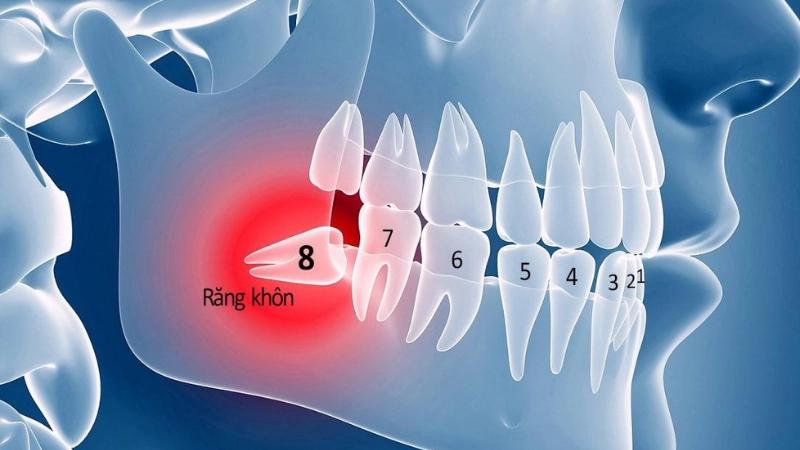 Răng khôn mọc lệch, mọc ngầm - Nên giữ lại hay nhổ bỏ?