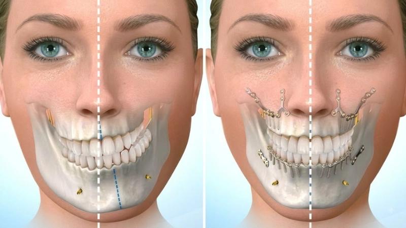 Phẫu thuật chỉnh hình hàm lệch - Kiến tạo gương mặt cân đối, hài hòa