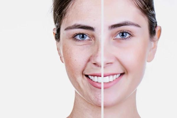Trẻ hóa da mặt là gì? Phương pháp trẻ hóa da đa công nghệ