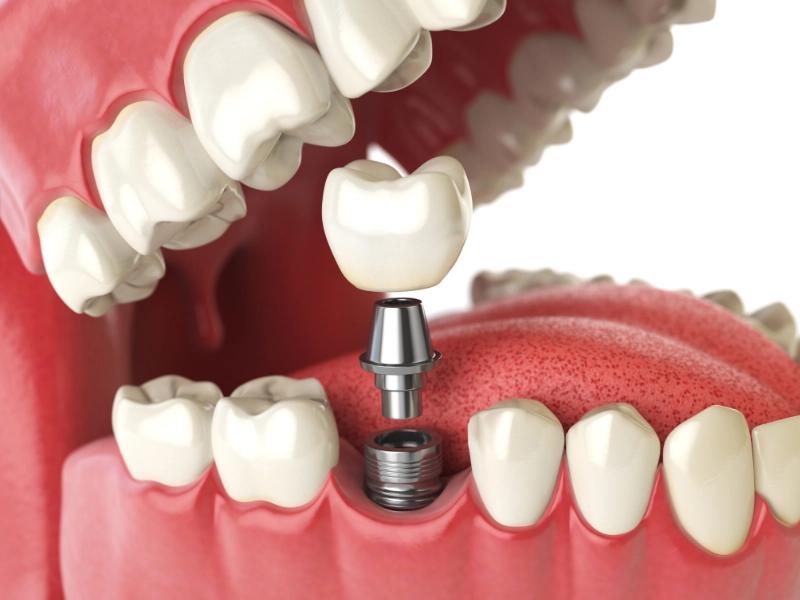 Trồng răng Implant - Ăn nhai như thật, bền chắc chọn đời