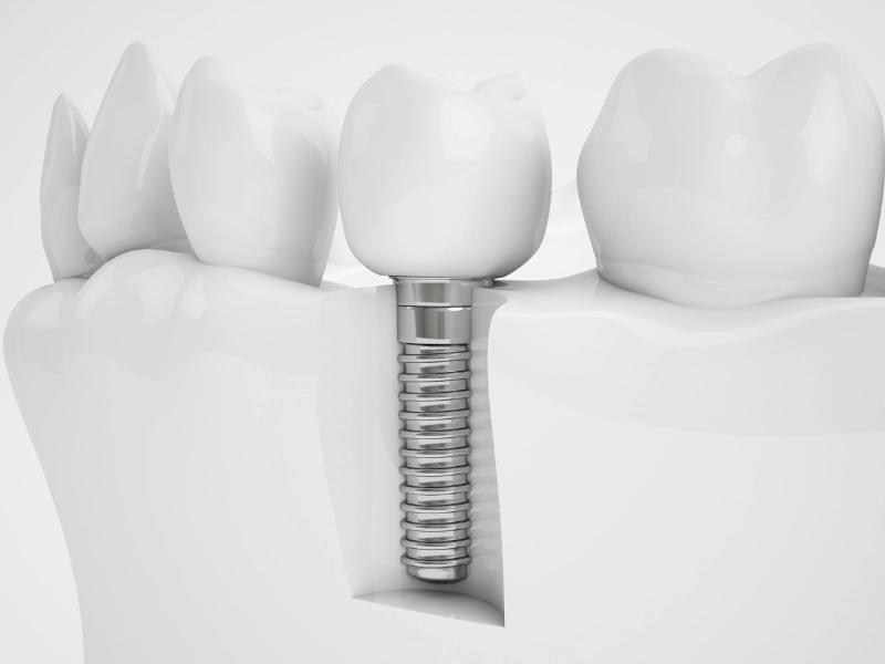 Trồng răng Implant - Ăn nhai như thật, bền chắc chọn đời 2