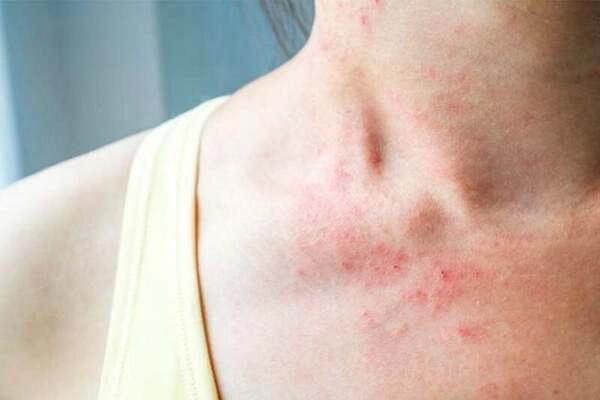 Viêm da cơ địa: Triệu chứng, tác hại và cách phòng ngừa