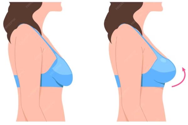 Nâng ngực sa trễ là gì? Giải pháp lấy lại vòng 1 săn chắc, cân đối