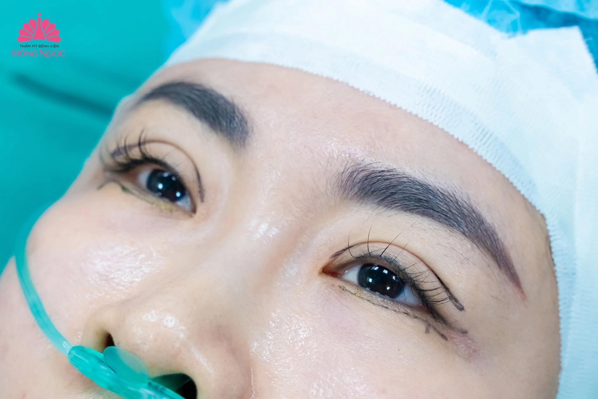 Chi phí lấy mỡ bọng mắt? Các yếu tố ảnh hưởng đến giá