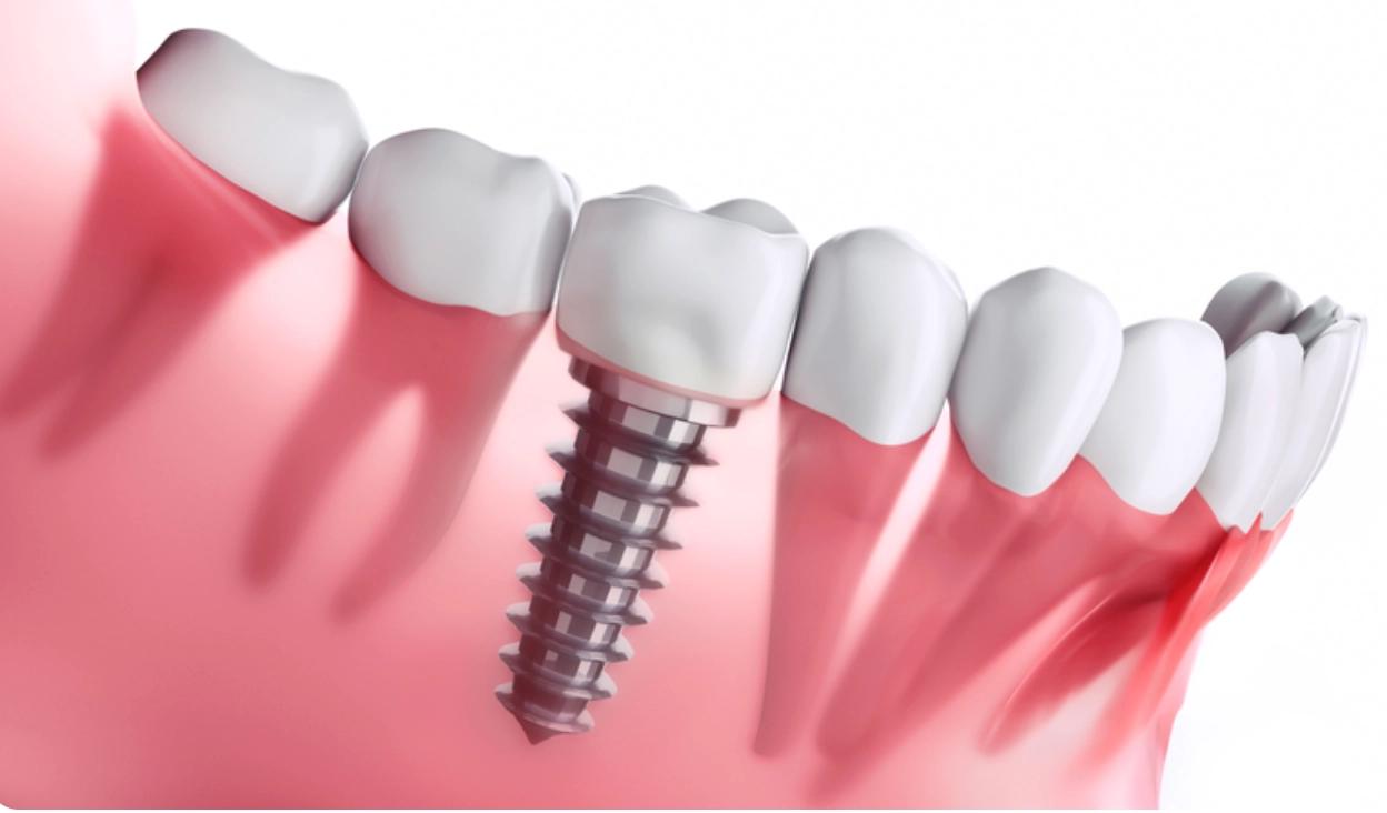 Trồng răng sứ cố định: Giải pháp cho ai và khi nào thực hiện?