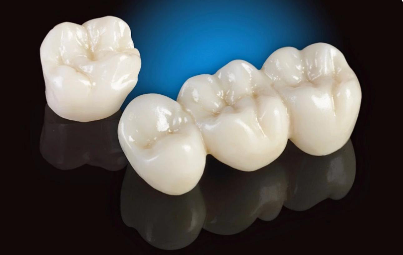 Bọc răng sứ Titan là gì? Có tốt không? Có mấy loại?