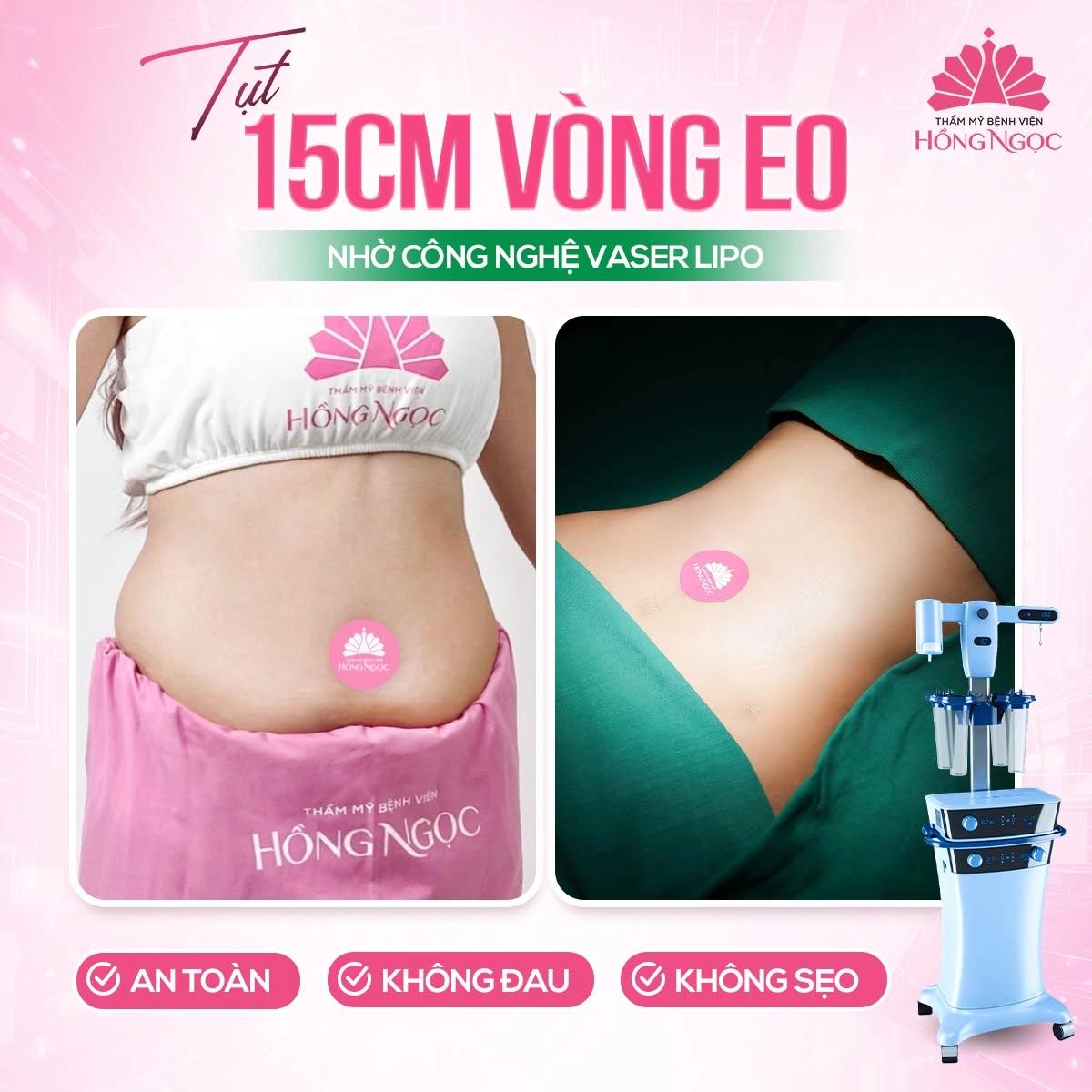Hút mỡ VASER Lipo kết hợp tạo hình thành bụng - Kiến tạo vòng eo săn chắc