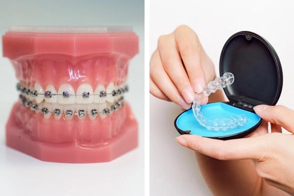 Nên niềng răng trong suốt hay mắc cài? So sánh ưu nhược điểm từng phương pháp