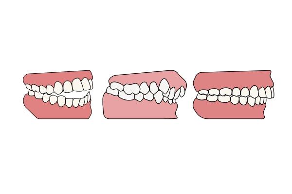 Sai khớp cắn là gì? Các tình trạng thường gặp và phương pháp điều trị hiệu quả