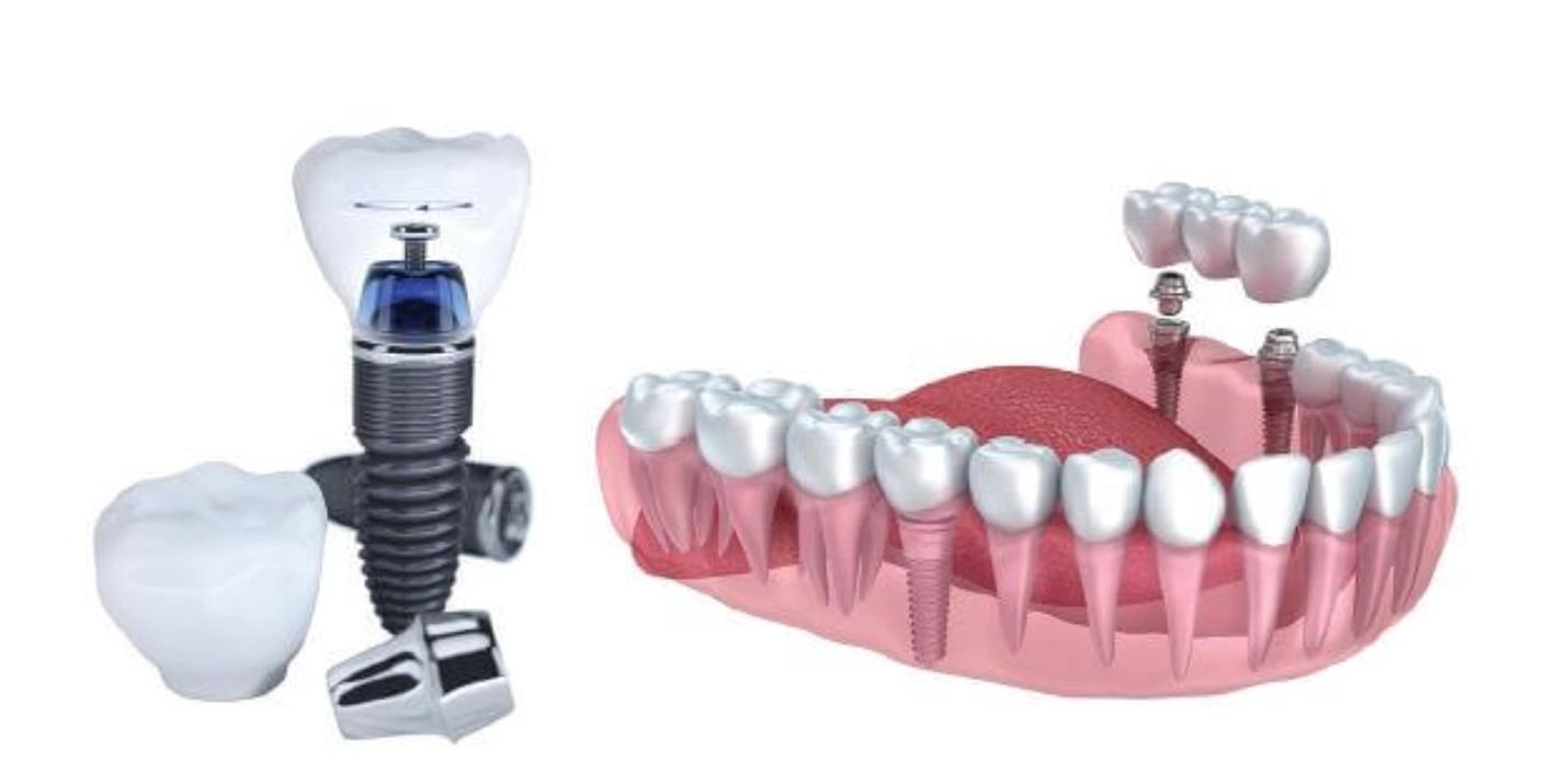 Trồng răng Implant có đau không? Mất bao lâu để phục hồi