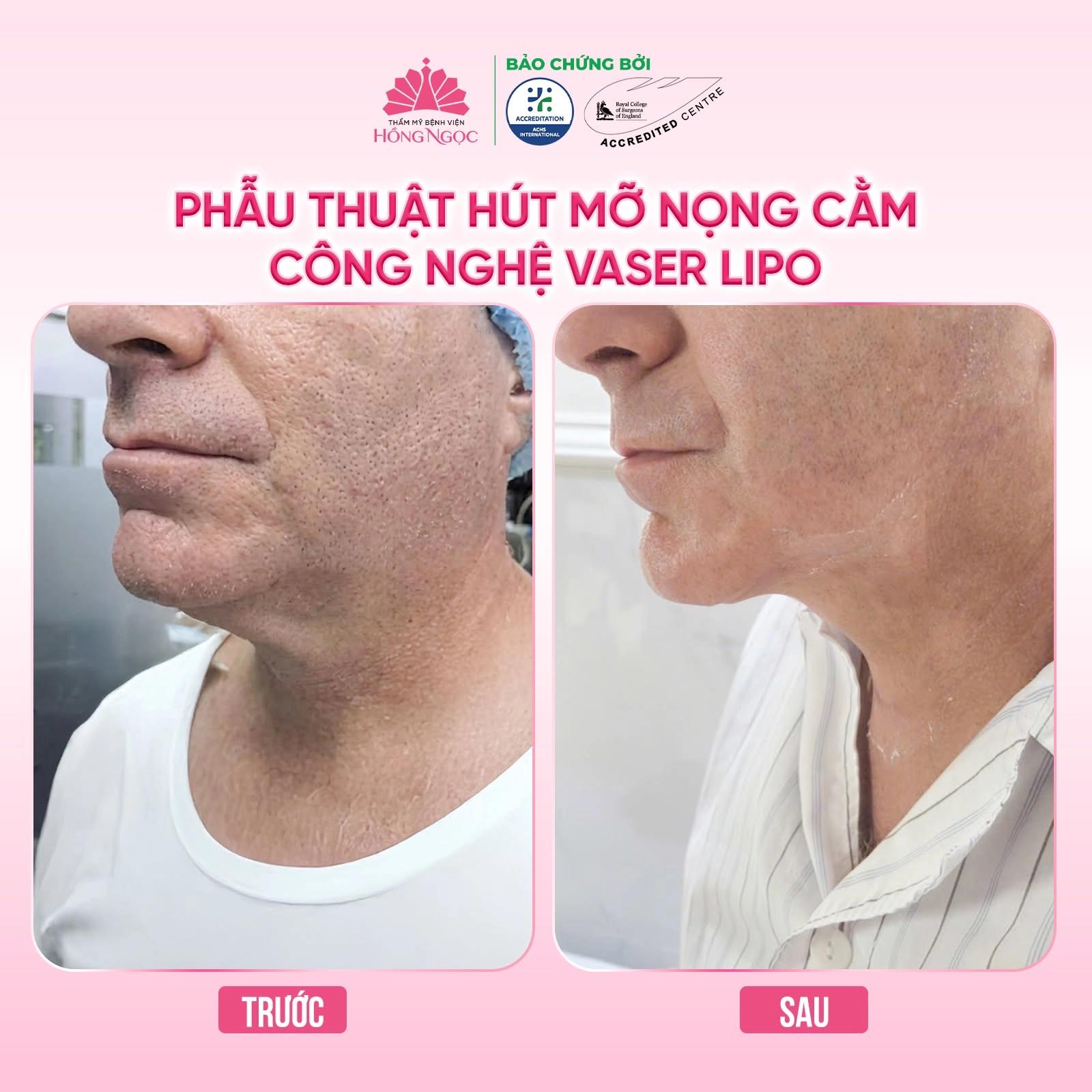Cách giảm mỡ mặt cho nam: Đánh bay nọng cằm nhanh chóng