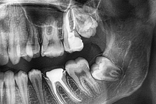 Nhổ răng khôn không đau với công nghệ Piezotome