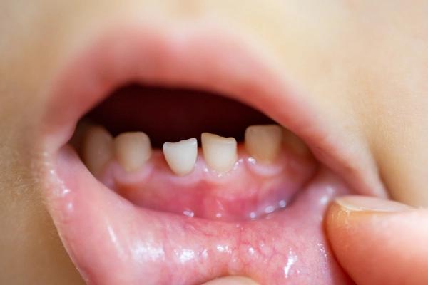 Tầm quan trọng của việc chăm sóc răng sữa cho bé