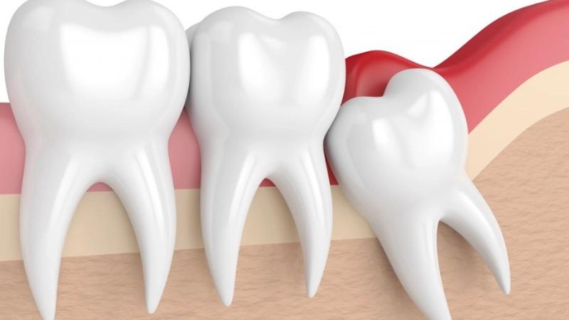 Nhổ răng khôn mọc ngầm - An toàn, Hiệu quả với kỹ thuật xâm lấn tối thiểu