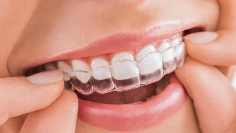 Niềng răng Invisalign - Giải pháp thẩm mỹ tối ưu cho người bận rộn