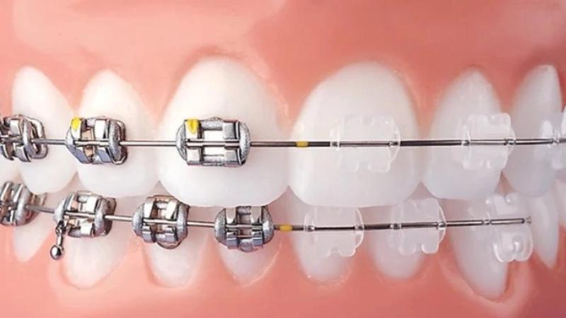 Nên chọn niềng răng mắc cài kim loại hay niềng răng mắc cài sứ?