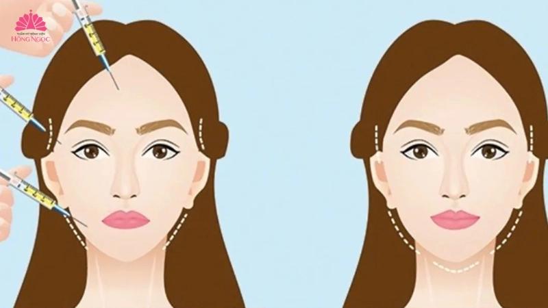 Cấy mỡ mặt - Giúp gương mặt trẻ hóa, đầy đặn, hài hòa