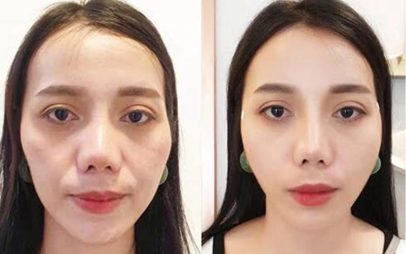 Độn rãnh cười - Phương pháp cải thiện rãnh sâu an toàn