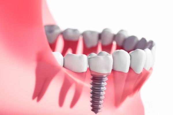 Giá trồng răng Implant bao nhiêu? Chi phí phụ thuộc vào những yếu tố nào?